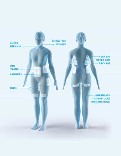 Coolsculpting 9 treatment areas