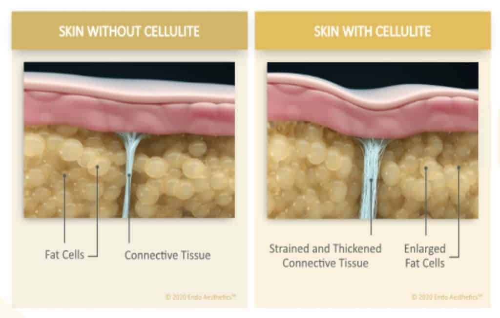 Connective tissue shown in skin with and without cellulite