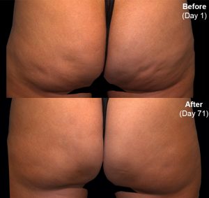 Before and after a full treatment of QWO for cellulite reduction.