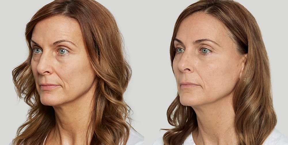 Sculptra restores youth through a collagen production process